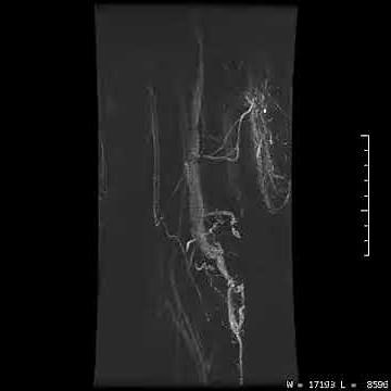 MRA acquisition of the arm