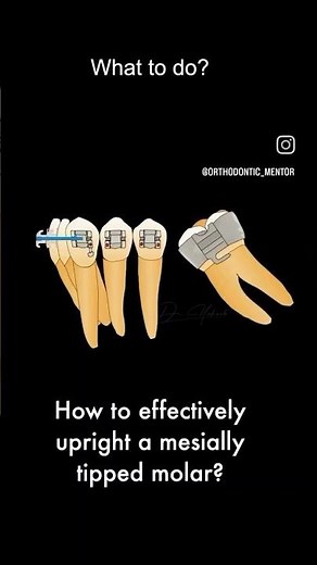 Molar Uprighting ( upright spring) || ortho mentor
