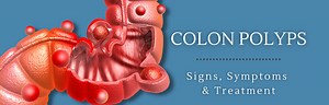 Colon Polyps: Signs, Symptoms, and Treatment - Gidoc Cape Town