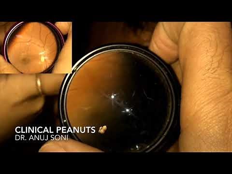 Central Serous Retinopathy (CSR) - CSCR