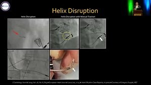 Extracting Conduction System Pacing Leads: What You Need to Know