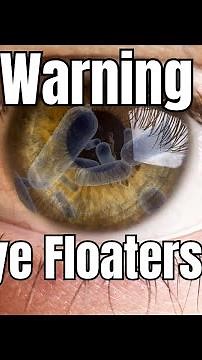 Eye Floaters Simple Explanation - What Are They?