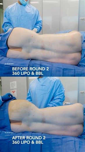 BEFORE & AFTER | 360 Lipo & BBL #fyp #liposuction #lipo360 #bbl #bbljourney #plasticsurgery #fypシ