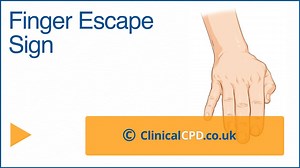 Video- Finger Escape Sign - Clinical CPD