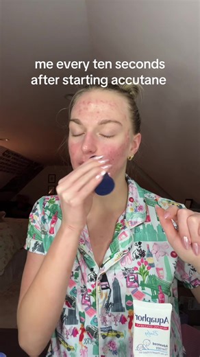 Managing Accutane Anxiety with Aquaphor