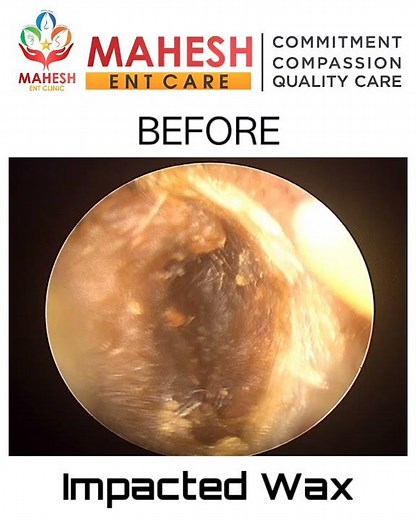 IMPACTED EAR WAX