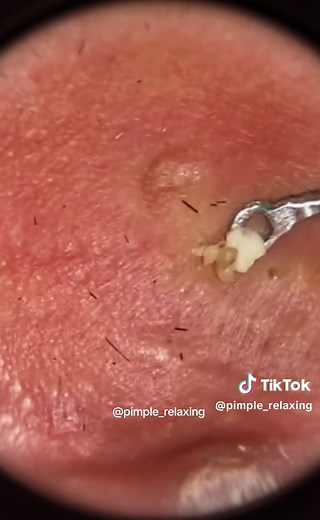 Satisfying Blackhead Removal Techniques