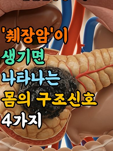 췌장암이 생기면 나타나는 몸의 구조신호 4가지 #췌장암