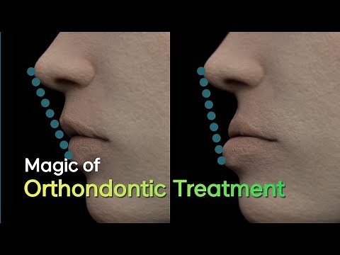 Orthodontic treatment, why you need it and how it's done