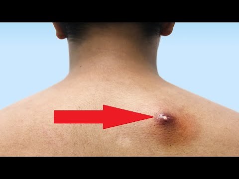 Receita para Secar furúnculos, Abscessos e Feridas com Pús