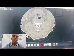 Dr. James reviews a CT myelogram from a French bulldog that had a hemilaminectomy during the week.