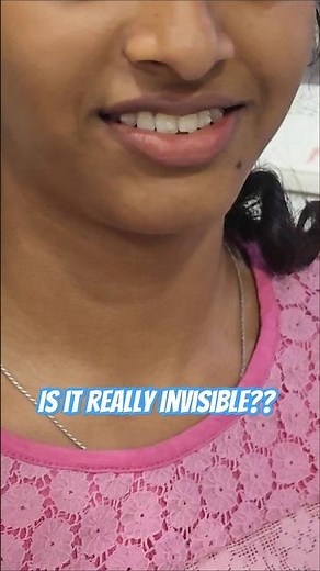 Wearing aligners for the first time!! #aligners #smiledesigndental #dentaltreatment #invisalign