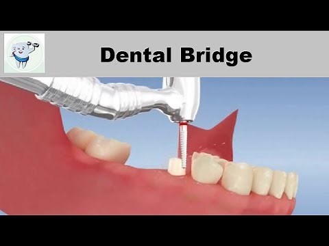 Dental Bridge Animation 3D