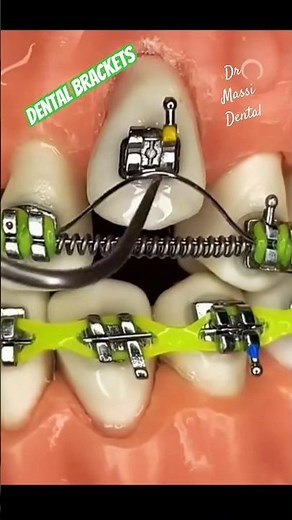 Glue the Dental Brackets, Braces Etching