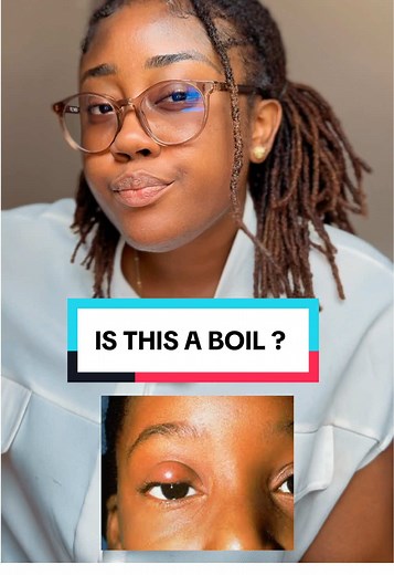 If you notice a small painless lump on your eyelid , don't panic! It's not Apollo, irs not boil , it's called Chalazion. The earlier you treat it, the faster it goes! #theactualeyedoctor #fyp