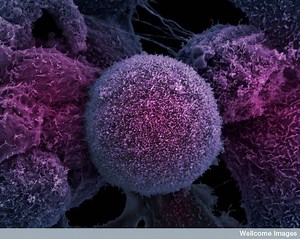 Cancer de la prostate : un traitement révolutionnaire aux ultrasons