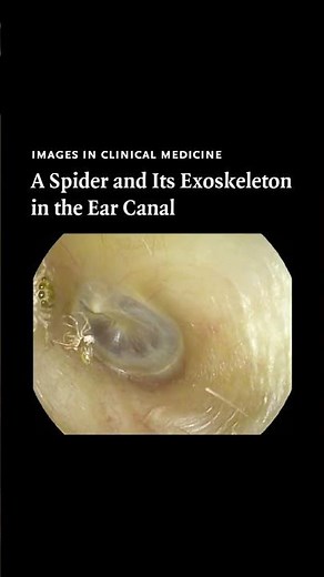 A Spider and Its Exoskeleton in the Ear Canal | NEJM