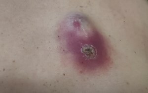Large Infected Back Cyst Pus Drainage