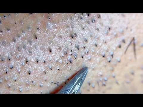 Using Tweezers on Beard Hairs !! #relaxing #tweezer #facialhair #hair #chin #ingrownhair #asmr
