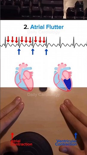 ECG interpretation made easy #ecg #ecginterpretation #atrialfibrillation #ventricularfibrillation