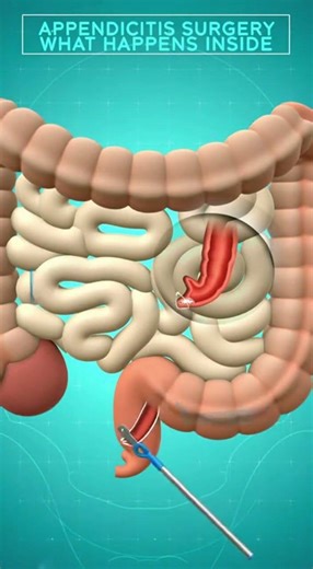 Appendix Inflammation Requires Emergency Surgery #shorts #health
