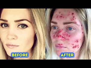 What if Ozone Layer Disappeared?