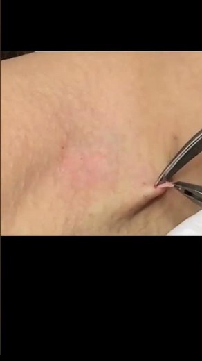 Steatocytoma in the axilla#drpimplepopper #SLMDskincare