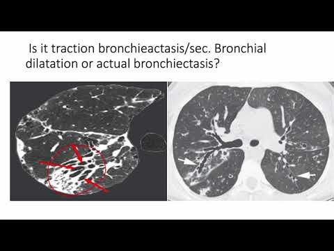 Traction bronchiectasis vs actual bronchiectasis