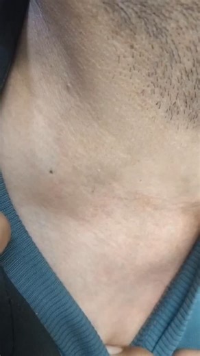Abnormal pulsatile swelling in neck. What can it be??##newpost #medstudent #shorts #medicine #medicallife #science #motivation #medical #neuroscience #newvideo #neetpg #neetpg #health #education #neuro #neurologist #trendingreels #instagood #instadaily #instalike #instamood #instagram | Med Wizards