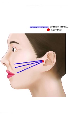 aestheticprocedures on Instagram: "Anatomical Considerations and Technique for Nasolabial Fold Thread Lifting Gi-Woong Hong Diagram showing lore (tympanoparotid) fascia extending from the tympanomastoid fissure to the parotid capsule, emphasizing its role as a key anchorage layer for thread lifting. The threads used are Sihler Bi lift 10 cm (Sihler inc., Korea). illustration locating the lateral maxillary (buccal) ligament lateral to the nasolabial fold and depicting its function in tethering sk