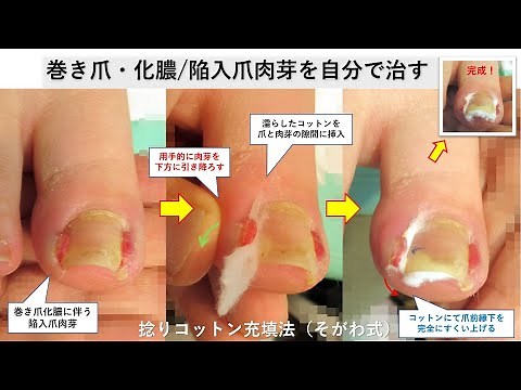 巻き爪化膿・陥入爪肉芽を自分で治す・治し方は？