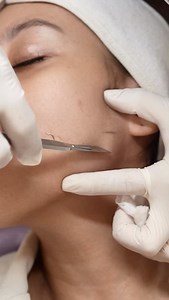 Why Dermaplaning: 1. Uses a medical-grade sterile blade 2. Removes dead skin cells peach fuzz 3. Exfoliates and smooths skin texture 4, Improves product absorption 5. Helps makeup apply smoothly and evenly Branches: Makati, Las Piñas and Quezon City #dermaplaning #skinglow #esthetics | Miss Derm