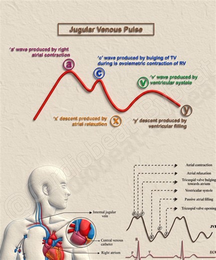 The Jugular Venous Pulse (JVP): A Window to the Right Heart The JVP waveform reflects right atrial hemodynamics. Mastering its variants is key to bedside diagnosis. 📈 Normal Waveform: ➡️ ‘a’ wave – Right atrial contraction ❤️ ➡️ ‘x’ descent – Atrial relaxation ⬇️ ➡️ ‘v’ wave – Ventricular systole (atrial filling) ➡️ ‘y’ descent – Ventricular filling (TV opens) 🚨 Pathological Variants: 🔴 Giant ‘a’ wave: Resistance to atrial emptying (e.g., Tricuspid Stenosis, Pulmonary Hypertension) 🚫 ⚡ Canno