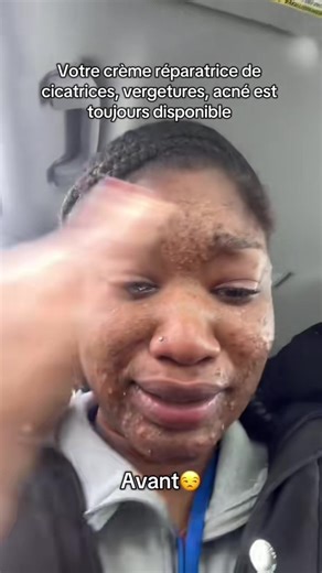 Crème Réparatrice pour Cicatrices et Vergetures