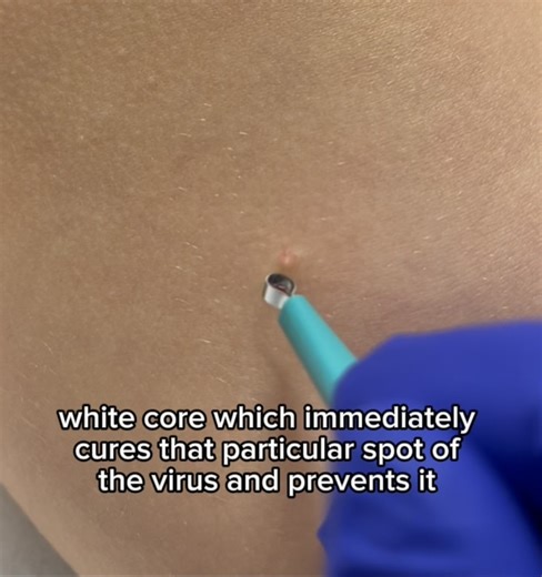 Claire Wolinsky, MD FAAD | Although the immune system will eventually recognize and fight this virus, the spread of Molluscum can go on for years and can be unsightly... | Instagram