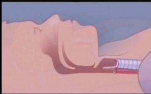 油管搬运/口译练习1/What is Apnea? /睡觉打鼾原理/呼吸暂停/