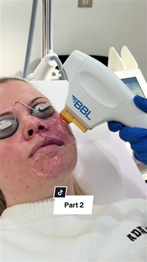BBL Laser Journey Part 2 at Bespoke Medical Clinic