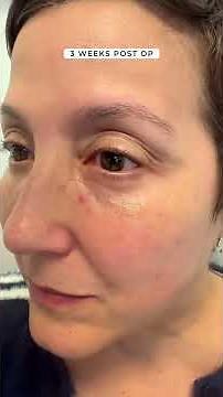 Lower blepharoplasty with fat repositioning fat grafting co2 laser
