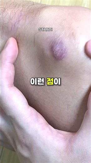 98%가 모르는 이렇게 생긴 점의 위험성