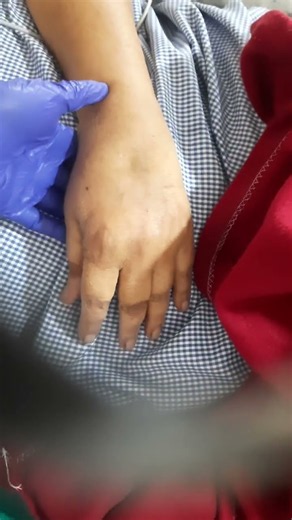 Resting tremor#Parkinsons diseae#Neuro rehab#Mobin Neuro PT