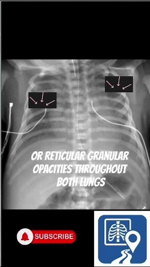 How to Read a Neonatal Chest X-Ray in 60 Seconds! #Shorts