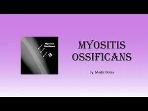 Myositis ossificans - causes, symptoms, investigation, treatment, prognosis