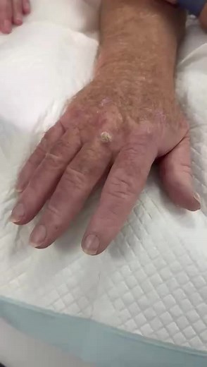 Understanding Squamous Cell Carcinoma Diagnosis