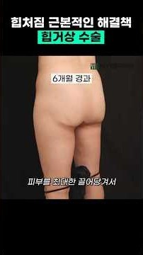 엉덩이 처짐을 근본적으로 개선하는 힙거상수술