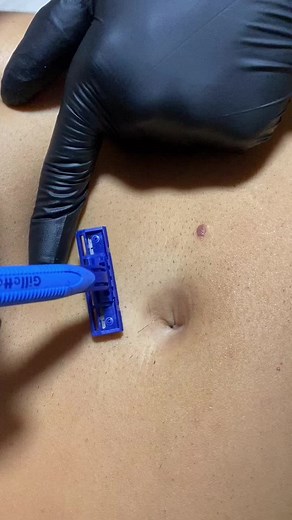 Tutti i passaggi per epilazione laser alla pancia😎✳️ #laserdiodo #work #neiperte #viral #laser #foryou