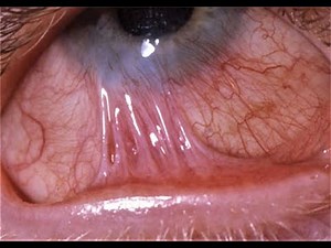 Symblepharon / Conjunctiva - Bulbar / Tarsal (Palpebral)/ Conjunctivitis /Conjunctivoplasty/ Dr Ram