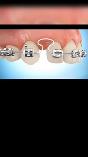 Braces are orthodontic devices used to straighten teeth