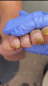 Satisfying Toenail Grooming | Gentle Foot Care Routine #fypシ #cleannails #RelaxingCare #fypシ | ADN Medical