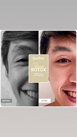 Say Hello to a more youthful YOU with Royal Prince Premium Botox👑 | Royal Prince Aesthetics Ph