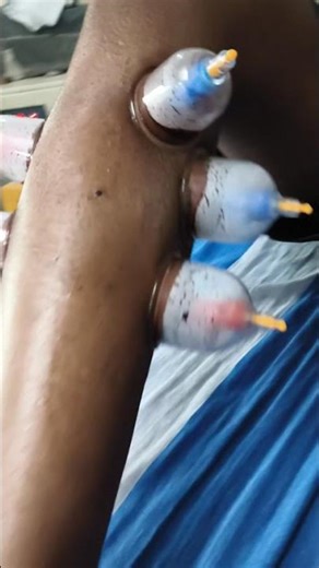 instant Pain Relief / Deep Cupping Therapy #shortsfeed #cupping #shorts #ytshorts #shortyz
